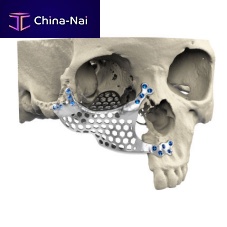 Custom-made periorbital implant