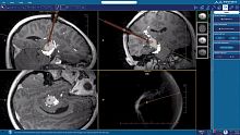 Medical imaging software NeuroBlate ® SoftwareTM NeuroBlate ®for radiation therapyneurosurgeryplanning