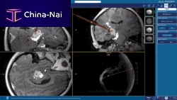 Medical imaging software NeuroBlate ® SoftwareTM NeuroBlate ®for radiation therapyneurosurgeryplanning