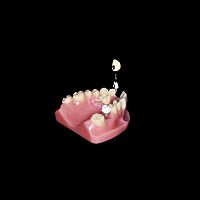 Titanium implant abutment zirconiaPEEKinternal