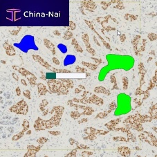 Oncology software module ONCOTOPIX® immunohistochemistryfor in situ fluorescence hybridizationvisualization
