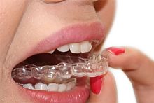 Dental aligner Smilers