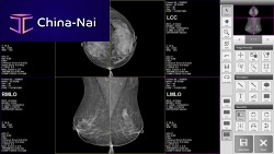 Mammography software BRESTATION LITEimage analysismanagementdiagnostic