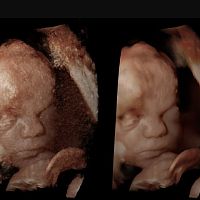 Ultrasound imaging software Rivent 3Dgynecologydata analysis3D viewing
