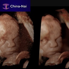 Ultrasound imaging software Rivent 3Dgynecologydata analysis3D viewing