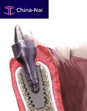 Healing screw IN-KONE®