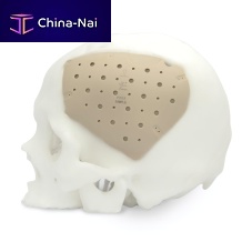 Custom-made cranial implant CranioPEEK3D 