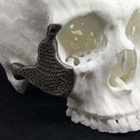 Custom-made periorbital implant non-absorbable