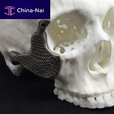 Custom-made periorbital implant non-absorbable