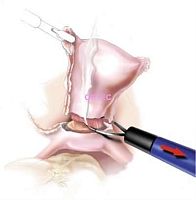 Laparoscopic electrode LapLoop wire loopmonopolar