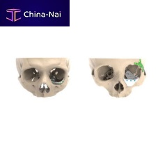 Custom-made periorbital implant non-absorbable