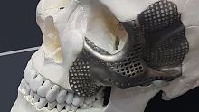 Custom-made periorbital implant OrthoCMFnon-absorbable