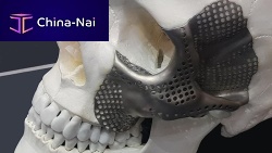 Custom-made periorbital implant OrthoCMFnon-absorbable