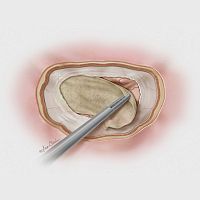 Porcine small intestinal submucosa dural substitute Biodesign®