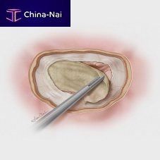 Porcine small intestinal submucosa dural substitute Biodesign®