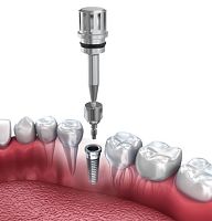 Cylindrical healing abutment titaniumscrew