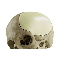 Custom-made cranial implant CROWN