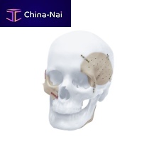 Custom-made cranial implant TRUMATCH