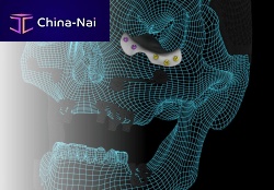 Custom-made periorbital implant ORBIT