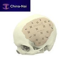 Custom-made cranial implant