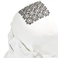 Cranial implant