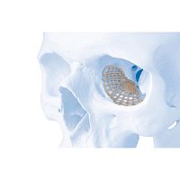 Non-absorbable periorbital implant MatrixORBITAL