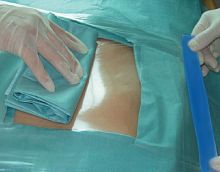 General surgery drape Incifilm®orthopedic surgerycardiac surgeryophthalmic surgery