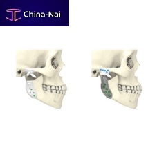 Custom-made mandibular implant TMJnon-absorbable
